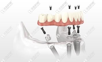 All-on-4種植牙技術(shù)