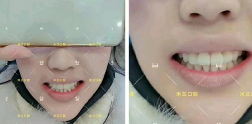 直到多生牙把門牙都擠變形了，才決定拔牙帶3M自鎖牙套矯正