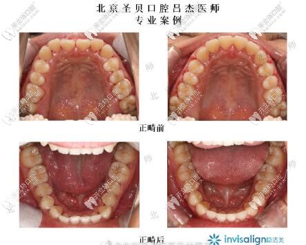 北京圣貝齒科呂杰隱形正畸案例前后對(duì)比 北京圣貝齒科呂杰隱形正畸案例前后對(duì)比