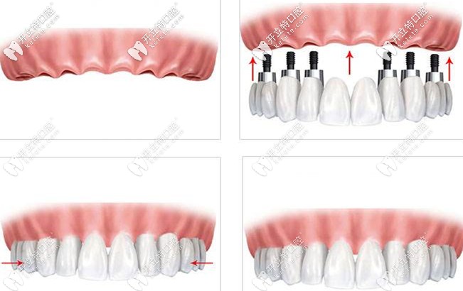分享老爸做All on 6半口種植牙的效果圖,原來(lái)all on six技術(shù)好贊