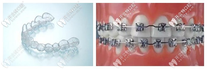 隱形牙套和金屬牙套對(duì)比圖示