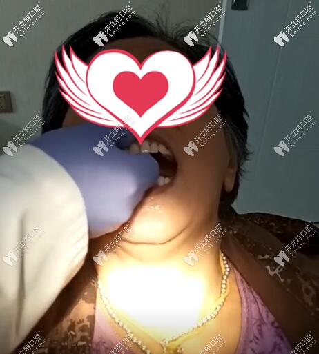 吉林吉誠(chéng)口腔吸附性義齒這人案例