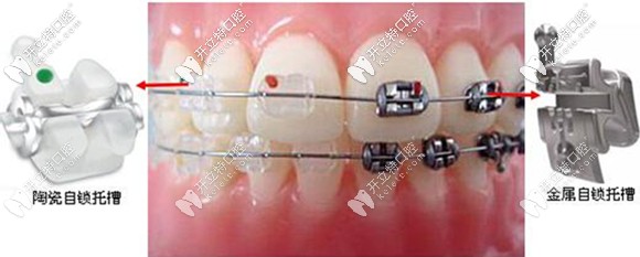 老少皆宜的金屬自鎖牙套