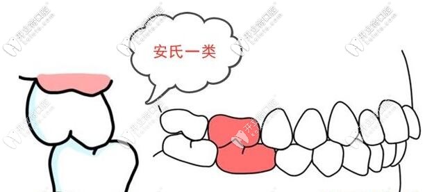 安氏一類錯頜畸形圖片