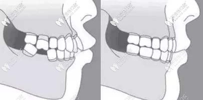 年輕人后牙缺失該選擇美國3i種植體的哪個型號？