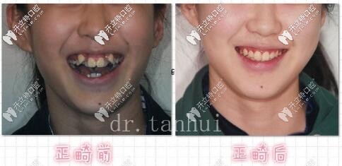牙齒不整齊亂成這樣,自鎖直絲弓矯正后只想說一句,真牛