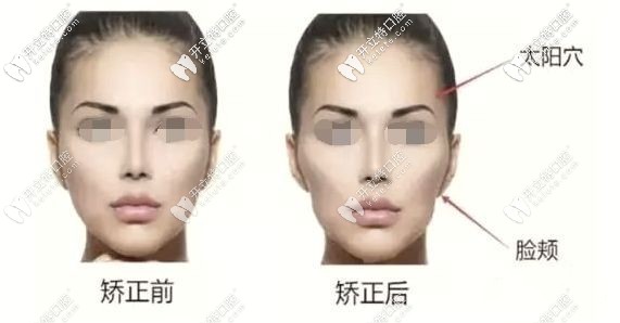牙齒矯正前后臉型變化圖