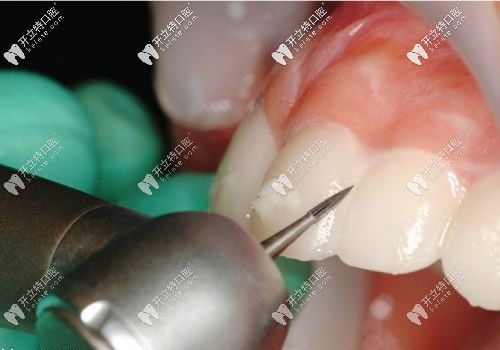 牙齒貼面過程中的磨牙