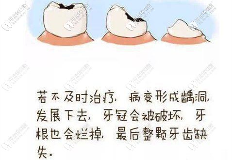 若不及時(shí)治療就會(huì)發(fā)展成重度齲齒