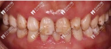 氟斑牙別指望冷光美白變白,說(shuō)下我做義獲嘉瓷貼面的感受