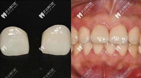 牙貼面效果圖