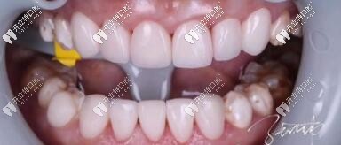 昆山美奧口腔門診部義獲嘉瓷貼面案例