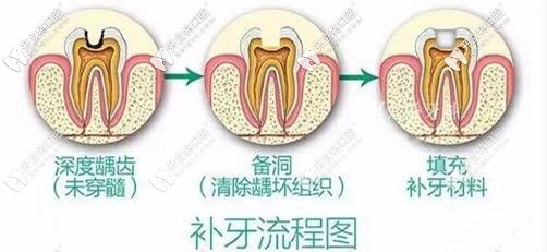 你們要的補(bǔ)牙流程圖來咯