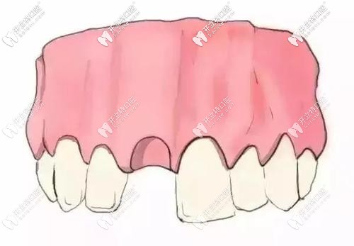 牙齒缺失外觀圖 牙齒缺失外觀圖