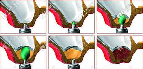 什么是上頜竇內(nèi)提升術(shù) 什么是上頜竇內(nèi)提升術(shù)