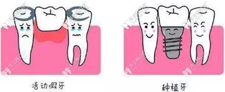 種植牙和活動(dòng)假牙不同
