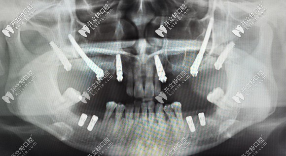 穿顴穿翼就是種植體植入到顴骨和翼板骨上的種植方法