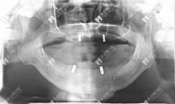 Locator全口種植覆蓋義齒的優(yōu)缺點