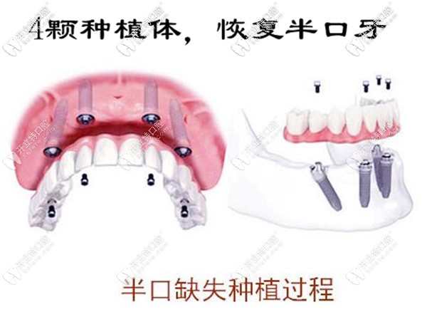寧波牙博士口腔allon4全口種植牙