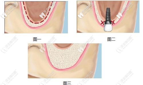 上頜竇提升術(shù)的優(yōu)缺點 上頜竇提升術(shù)的優(yōu)缺點