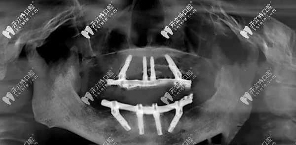 我牙槽骨缺失做全口種植牙的效果