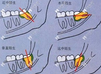 阻生智齒會引發(fā)的危害