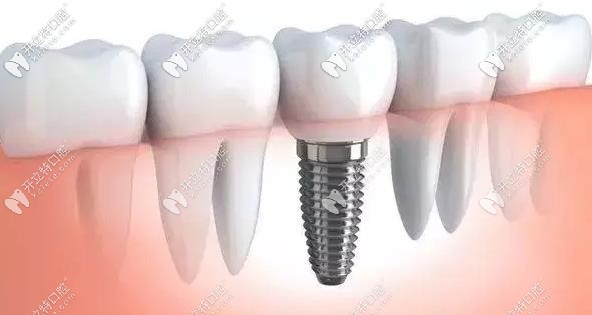 種植牙 種植牙