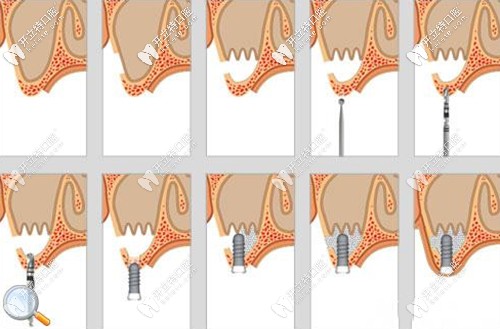 <!--<i data=20240703-sp></i>-->民講解種植修復(fù)中的骨劈開和骨擠壓手術(shù) <!--<i data=20240703-sp></i>-->民講解種植修復(fù)中的骨劈開和骨擠壓手術(shù)