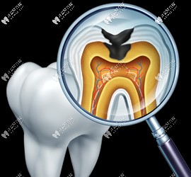 局部清潔死角可能會引發(fā)齲齒