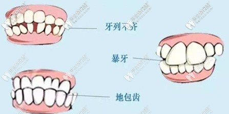 牙列不齊對(duì)面貌和咬合都有影響