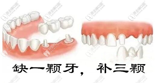 做全瓷牙和烤瓷牙缺一補三