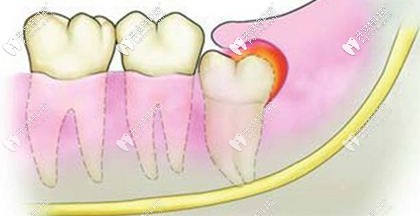 可能引發(fā)智齒冠周炎