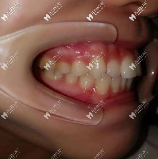  曬戴隱適美牙套內收前突牙效果圖,齙牙矯正280天下巴出來了