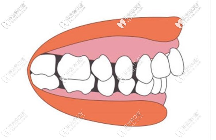 隱形牙套和鋼絲牙套哪個(gè)效果更好