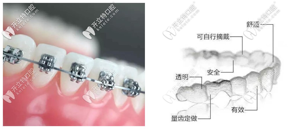 矯正齙牙隱形牙套和鋼絲哪個(gè)更快?利弊分析后發(fā)現(xiàn)區(qū)別是…