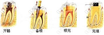 開髓、備根、根充以及填充