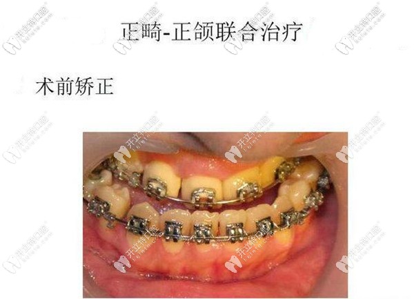 正頜手術前正畸的目的是什么