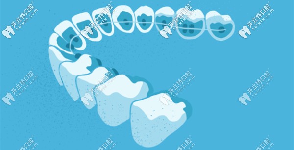 3D隱形矯正的原理 3D隱形矯正的原理