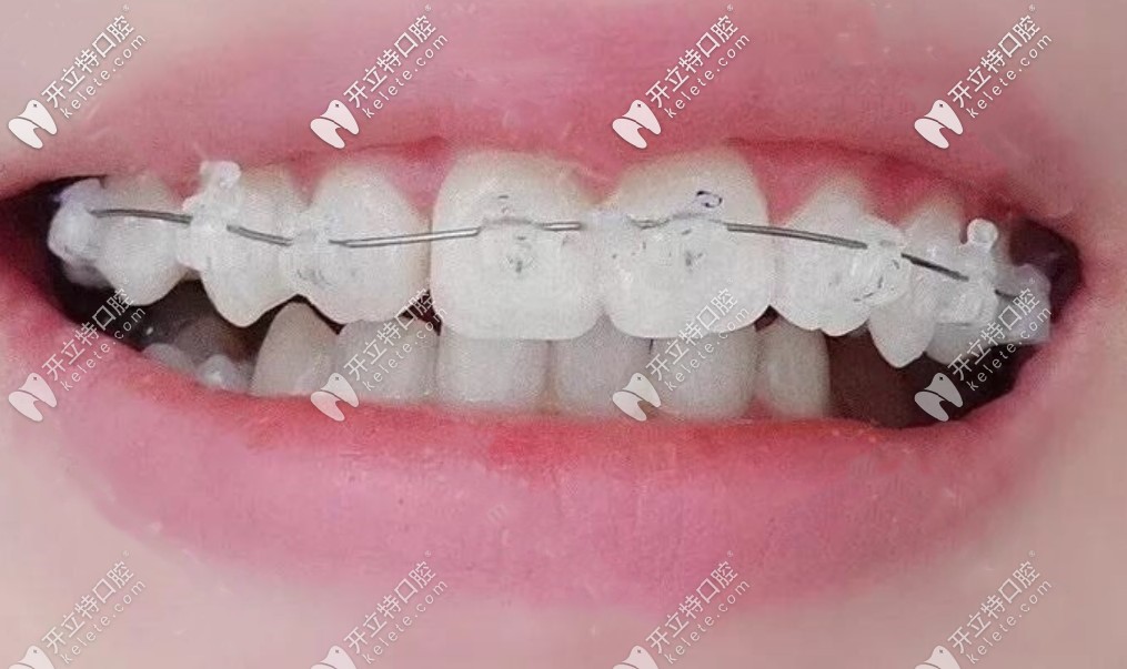 我戴上陶瓷自鎖托槽效果圖