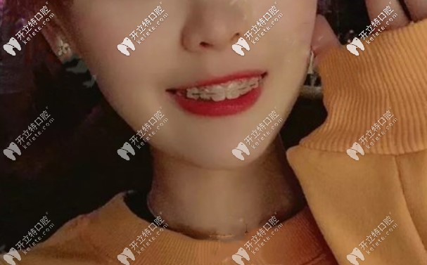門牙齙牙戴陶瓷自鎖牙套矯正380天，大家看我嘴巴還凸嗎