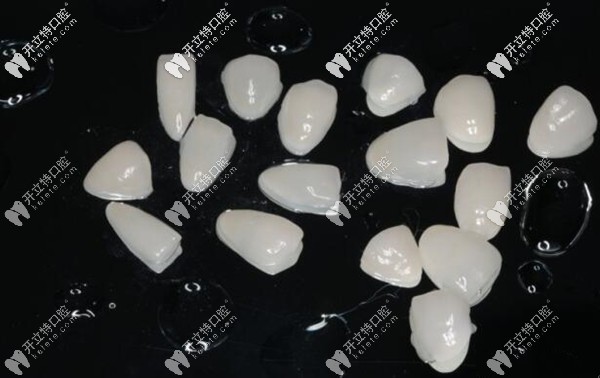 重度氟斑牙在合肥壹加壹做瓷貼面修復(fù)