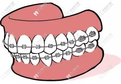 原來(lái)傳統(tǒng)鋼絲矯正一副多少錢，跟牙套上的弓絲有關(guān)啊