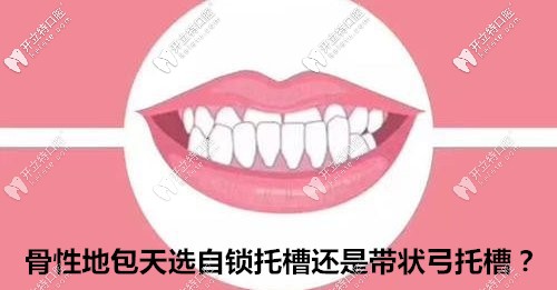 據(jù)說(shuō)骨性地包天用全同步帶狀弓矯正比戴自鎖牙套好?真or假