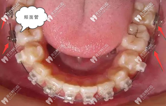 正畸頰面管的優(yōu)缺點(diǎn)介紹