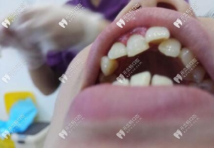 ?？谖⑿谇会t(yī)院正畸案例