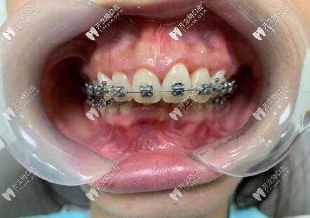 ?？谖⑿谇会t(yī)院 金屬托槽正畸真人案例