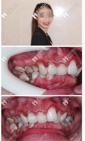 牙不齊深覆合3m自鎖托槽矯正5個(gè)月,點(diǎn)贊海口這家高大上牙科