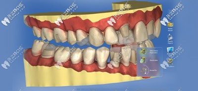3D手術(shù)導板打印