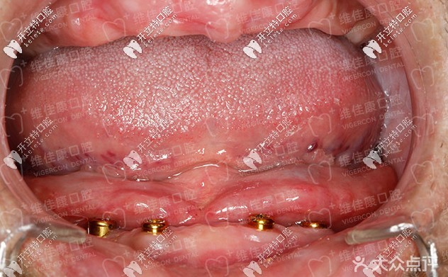 60歲王大爺做allon4全口快速種植牙花了十多萬，兒子卻說……