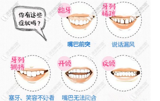 五大牙齒畸形的癥狀